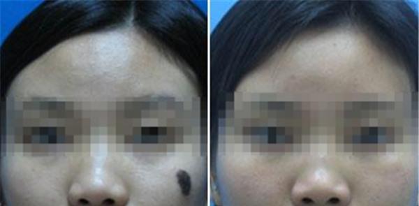 做<a href=http://m.f3bb6.cn/listinfo-788-0.html target=_blank class=infotextkey>去黑痣</a>價格大概需要多少