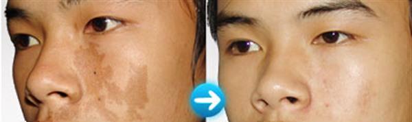 激光<a href=http://m.f3bb6.cn/listinfo-774-0.html target=_blank class=infotextkey>去雀斑</a>麻醉方式是什么?