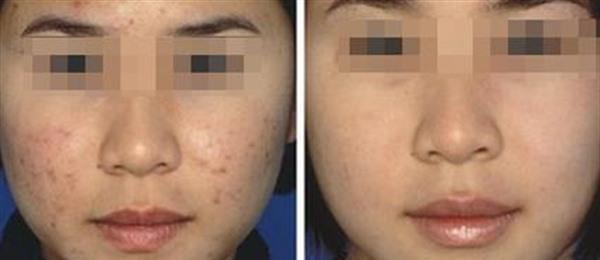 激光祛痘麻醉方式是什么?