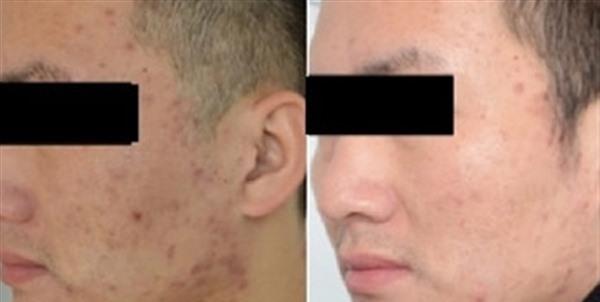 <a href=http://m.f3bb6.cn/listinfo-768-0.html target=_blank class=infotextkey>微針</a><a href=http://m.f3bb6.cn/listinfo-770-0.html target=_blank class=infotextkey>嫩膚</a>適應癥狀是什么？