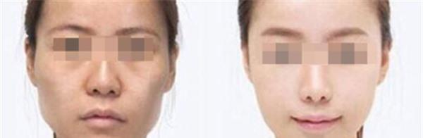 做E光美白不適應(yīng)人群有哪些