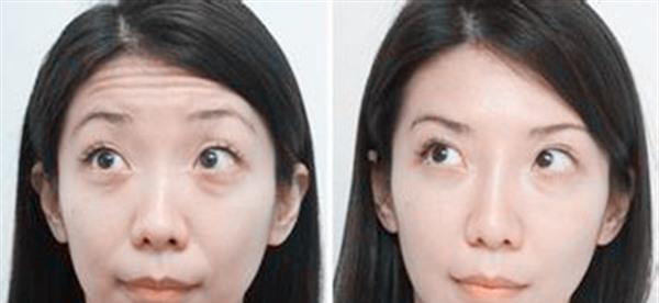 小切口<a href=http://m.f3bb6.cn/listinfo-614-0.html target=_blank class=infotextkey>除皺</a><a href=http://m.f3bb6.cn/listinfo-765-0.html target=_blank class=infotextkey>去抬頭紋</a>效果怎么樣？