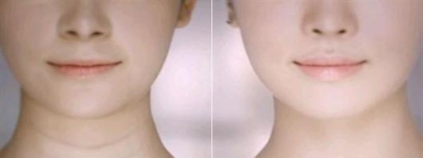 <a href=http://m.f3bb6.cn/listinfo-731-0.html target=_blank class=infotextkey>玻尿酸</a>除頸紋手術(shù)缺點(diǎn)有哪些？