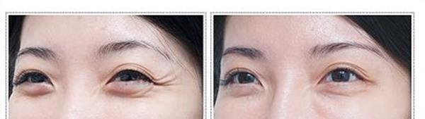 做<a href=http://m.f3bb6.cn/listinfo-731-0.html target=_blank class=infotextkey>玻尿酸</a><a href=http://m.f3bb6.cn/listinfo-782-0.html target=_blank class=infotextkey>去眼角細紋</a>價格要多少