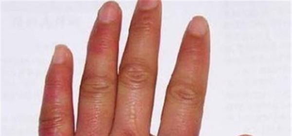 做凍瘡疤痕修復(fù)價格多少錢