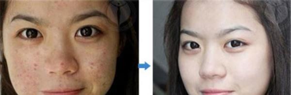 做脈沖光去痘印價格多少錢