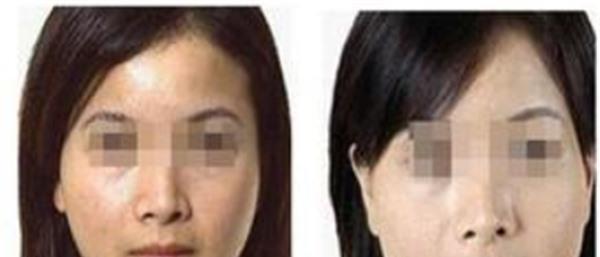 做自體脂肪<a href=http://m.f3bb6.cn/listinfo-797-0.html target=_blank class=infotextkey>去痘疤</a>價格多少錢