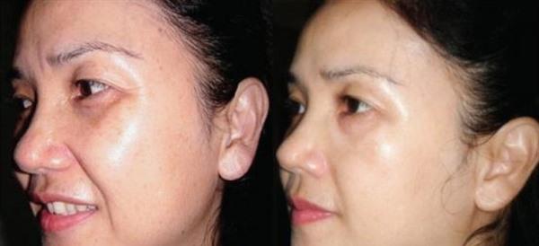 做化學剝脫<a href=http://m.f3bb6.cn/listinfo-786-0.html target=_blank class=infotextkey>去黃褐斑</a>價格貴不貴