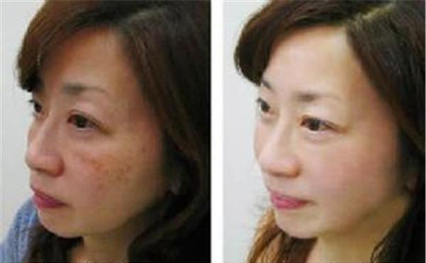 做冷凍法<a href=http://m.f3bb6.cn/listinfo-786-0.html target=_blank class=infotextkey>去黃褐斑</a>價(jià)格