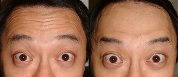 做額顳部<a href=http://m.f3bb6.cn/listinfo-614-0.html target=_blank class=infotextkey>除皺</a><a href=http://m.f3bb6.cn/listinfo-765-0.html target=_blank class=infotextkey>去抬頭紋</a>費(fèi)用大概需要多少