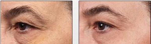 做激光<a href=http://m.f3bb6.cn/listinfo-782-0.html target=_blank class=infotextkey>去眼角細紋</a>費用大概需要多少