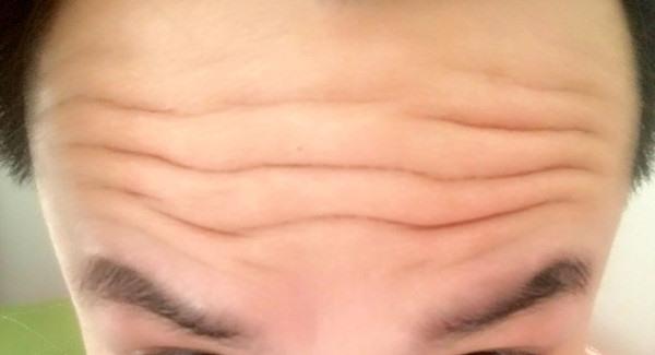 做激光去除抬頭紋手術注意事項是什么?