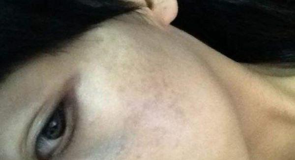 做剝脫治療<a href=http://m.f3bb6.cn/listinfo-774-0.html target=_blank class=infotextkey>去雀斑</a>手術注意事項是什么？