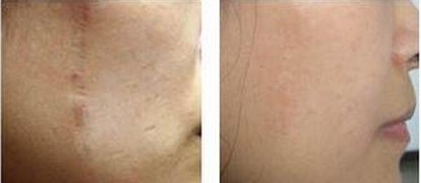 疤痕增生修復多久能恢復?