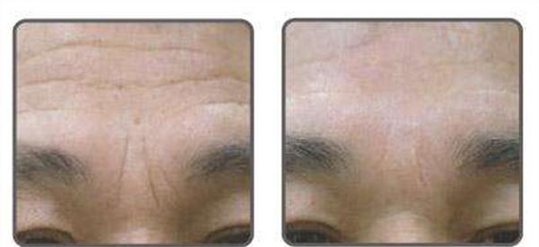 自體脂肪<a href=http://m.f3bb6.cn/listinfo-771-0.html target=_blank class=infotextkey>去眉間紋</a>手術安全嗎？