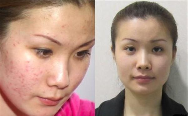 做激光祛痘多少錢