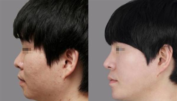 做<a href=http://m.f3bb6.cn/listinfo-797-0.html target=_blank class=infotextkey>去痘疤</a>失敗修復(fù)多少錢