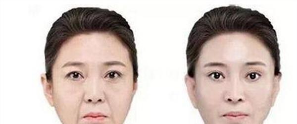 做自體脂肪<a href=http://m.f3bb6.cn/listinfo-792-0.html target=_blank class=infotextkey>去法令紋</a>多少錢