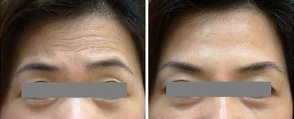 <a href=http://m.f3bb6.cn/listinfo-731-0.html target=_blank class=infotextkey>玻尿酸</a><a href=http://m.f3bb6.cn/listinfo-765-0.html target=_blank class=infotextkey>去抬頭紋</a>手術(shù)注意事項是什么？