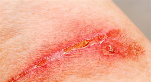 復合<a href=http://m.f3bb6.cn/listinfo-783-0.html target=_blank class=infotextkey>祛疤</a>的術后如何護理