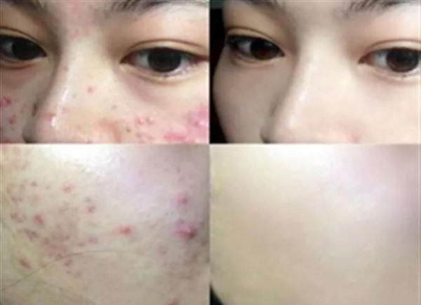 激光祛痘能夠根治嗎