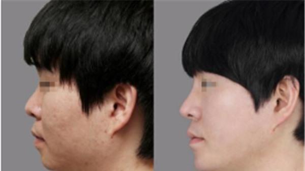 做<a href=http://m.f3bb6.cn/listinfo-734-0.html target=_blank class=infotextkey>愛貝芙</a><a href=http://m.f3bb6.cn/listinfo-797-0.html target=_blank class=infotextkey>去痘疤</a>不適應人群有哪些