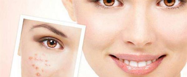 E光去痘印適應(yīng)癥狀是什么？