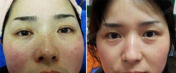 做剝脫治療<a href=http://m.f3bb6.cn/listinfo-774-0.html target=_blank class=infotextkey>去雀斑</a>費用大概需要多少