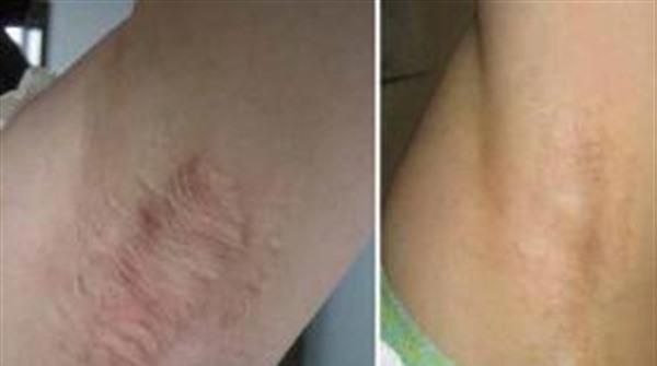 做剝離<a href=http://m.f3bb6.cn/listinfo-784-0.html target=_blank class=infotextkey>去狐臭</a>手術(shù)多少錢？