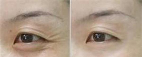 做<a href=http://m.f3bb6.cn/listinfo-734-0.html target=_blank class=infotextkey>愛貝芙</a><a href=http://m.f3bb6.cn/listinfo-780-0.html target=_blank class=infotextkey>去魚尾紋</a>費用多少錢