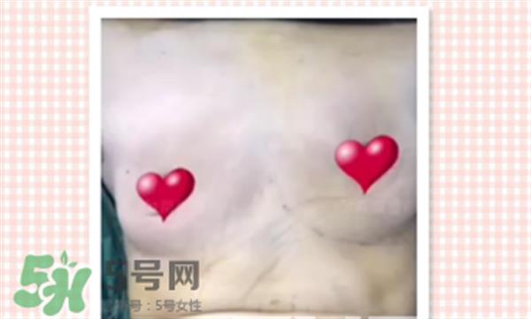 假體<a href=http://m.f3bb6.cn/listinfo-618-0.html target=_blank class=infotextkey>隆胸</a>取出后圖片 <a href=http://m.f3bb6.cn/listinfo-618-0.html target=_blank class=infotextkey>隆胸</a>假體取一月圖片