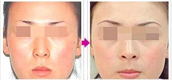 做果酸美白風險有哪些