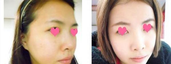 <a href=http://m.f3bb6.cn/listinfo-768-0.html target=_blank class=infotextkey>微針</a><a href=http://m.f3bb6.cn/listinfo-770-0.html target=_blank class=infotextkey>嫩膚</a>手術安全嗎？