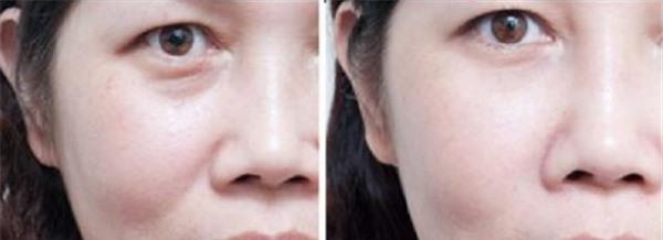 膠原蛋白<a href=http://m.f3bb6.cn/listinfo-792-0.html target=_blank class=infotextkey>去法令紋</a>適合哪種人？