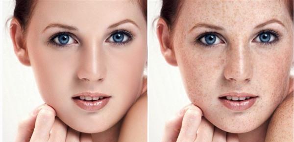 治療黃褐斑價格