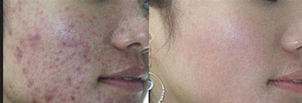 激光<a href=http://m.f3bb6.cn/listinfo-783-0.html target=_blank class=infotextkey>祛疤</a>的效果是怎樣的