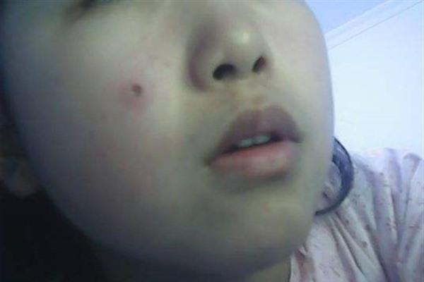 激光點痣項目要多少錢