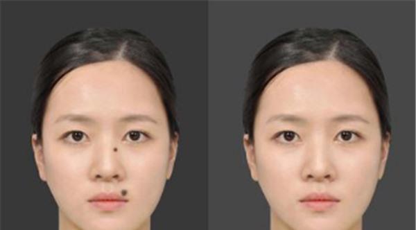 做點痣不適應人群有哪些