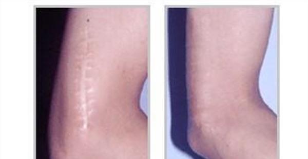 疤痕增生修復麻醉方式是什么?