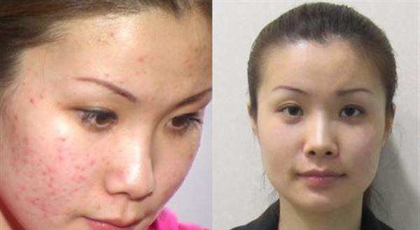 做激光<a href=http://m.f3bb6.cn/listinfo-786-0.html target=_blank class=infotextkey>去黃褐斑</a>價格貴不貴