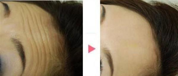 內窺鏡<a href=http://m.f3bb6.cn/listinfo-614-0.html target=_blank class=infotextkey>除皺</a><a href=http://m.f3bb6.cn/listinfo-765-0.html target=_blank class=infotextkey>去抬頭紋</a>手術安全嗎？