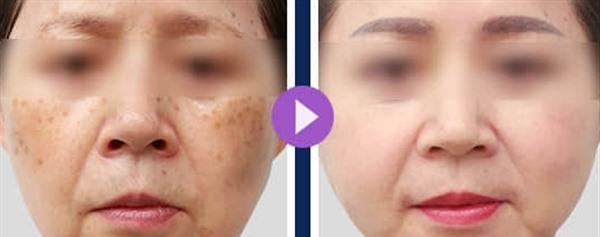 <a href=http://m.f3bb6.cn/listinfo-786-0.html target=_blank class=infotextkey>去黃褐斑</a>的方法