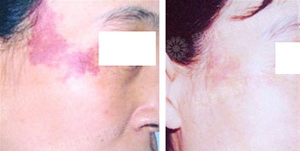 手術(shù)去除胎記價(jià)格