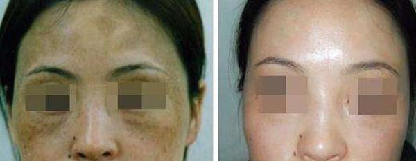 皮膚磨削治太田痣手術安全嗎？