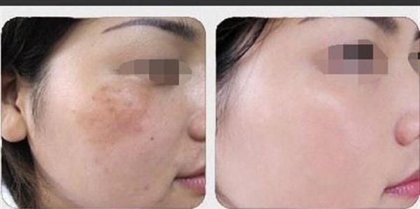 做激光<a href=http://m.f3bb6.cn/listinfo-786-0.html target=_blank class=infotextkey>去黃褐斑</a>副作用是什么