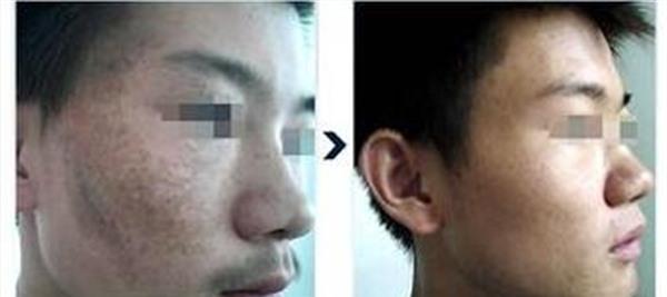 做<a href=http://m.f3bb6.cn/listinfo-799-0.html target=_blank class=infotextkey>去太田痣</a>費用大概需要多少