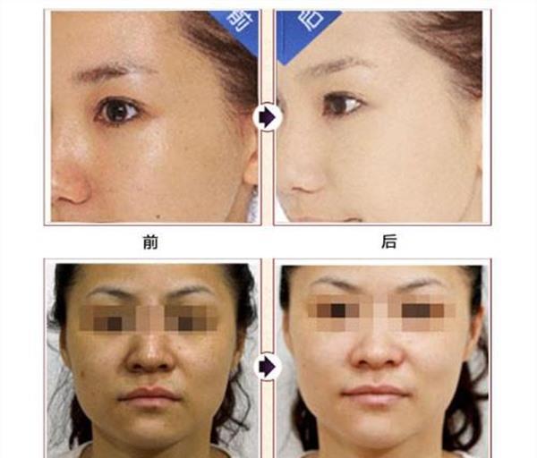 做E光美白費用大概需要多少