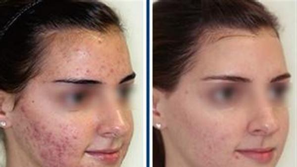 激光祛痘手術安全嗎？