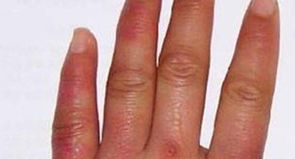 做凍瘡疤痕修復(fù)手術(shù)注意事項(xiàng)是什么？