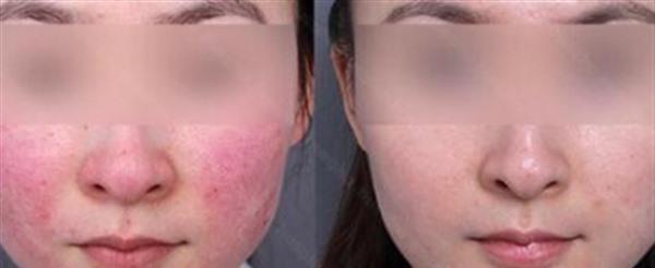 紅血絲用激光法能根治嗎